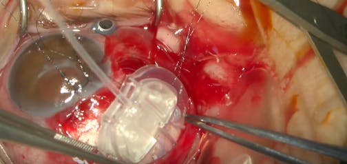 Ahmed Valve Implantation