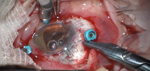 Dislocated IOL and Spontaneous Filtering Bleb in Patient With Marfan Syndrome