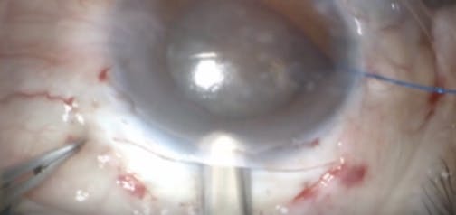 MSICS as Primary or Rescue Technique for Hard Cataracts