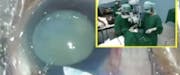 Sutureless Extracapsular Cataract Surgery