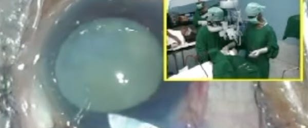 Sutureless Extracapsular Cataract Surgery thumbnail