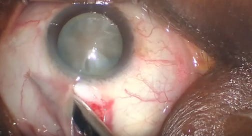 Transitioning to MSICS From Phaco