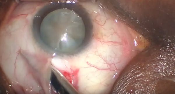 Transitioning to MSICS From Phaco thumbnail