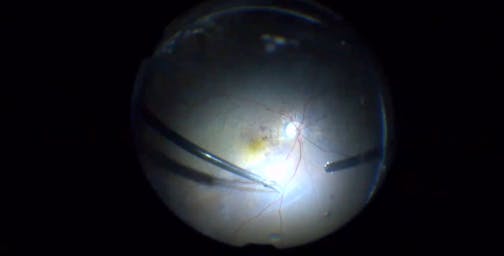 Sub-Silicone Oil Retinal Detachment With Intrinsic PVR