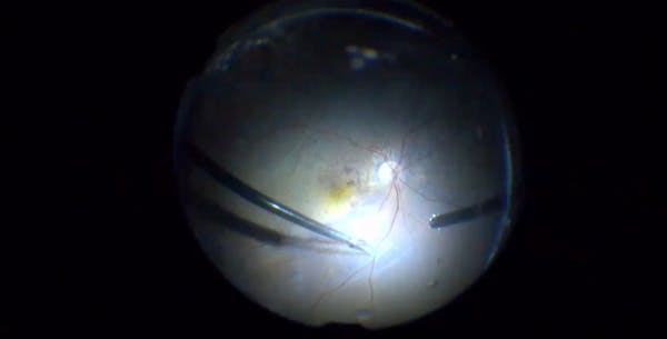 Sub-Silicone Retinal Detachment With Intrinsic PVR thumbnail