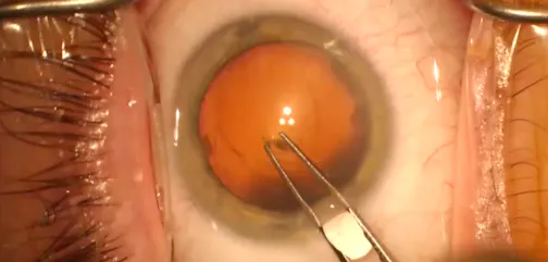 Beginning the Capsulorhexis
