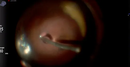 Freeze-Thaw Technique With Cryotherapy