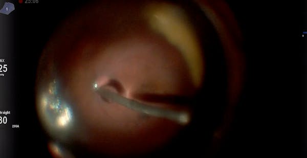 Freeze-Thaw Technique With Cryotherapy thumbnail