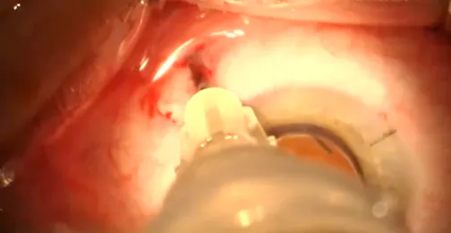 Posterior Sub-Tenon's Infusions