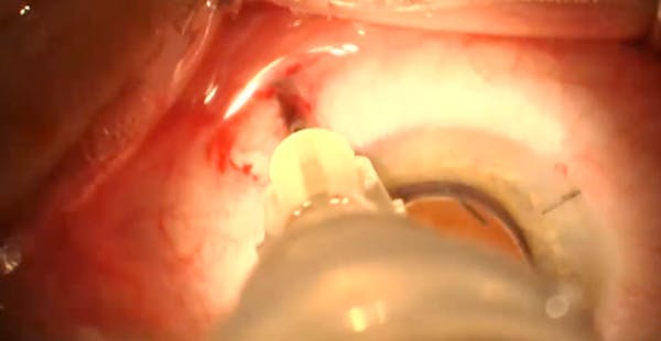 Posterior Sub-Tenon's Infusions thumbnail