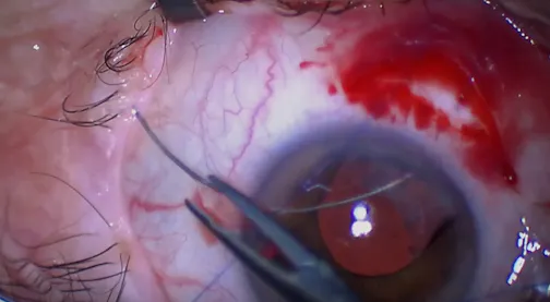 Scleral Fixation of In-Bag Toric IOL