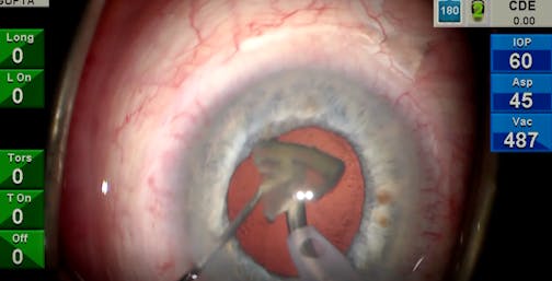 Zero CDE Removal of Dense Post-Vitrectomy Cataract