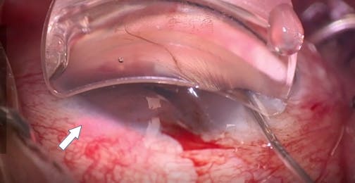 iTrack Advance Canaloplasty With Pressurized Viscodelivery