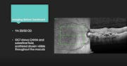 Real-World Switch Case: Wet AMD Therapy in a Patient Averse to Injections