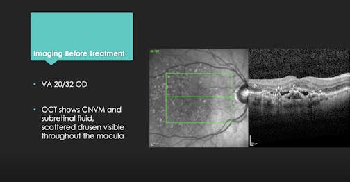 Real-World Switch Case: Wet AMD Therapy in a Patient Averse to Injections