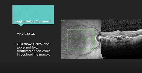Real-World Switch Case: Wet AMD Therapy in a Patient Averse to Injections thumbnail