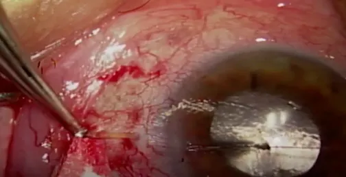 Recovering a Xen Gel Stent Implant