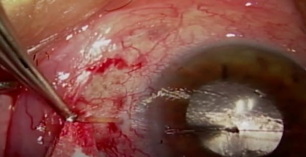 Rescuing a MIGS Implant thumbnail