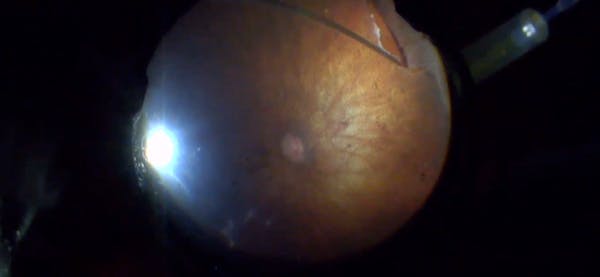 Posterior Tear in a Highly Myopic Eye thumbnail