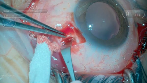 Prophylactic Sclerostomy in Nanophthalmos thumbnail