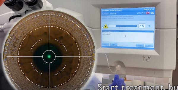 Cap-to-Flap Technique for SMILE Enhancement thumbnail