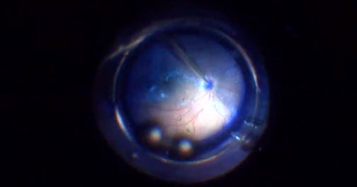 Bullous Retinal Detachment With PVR