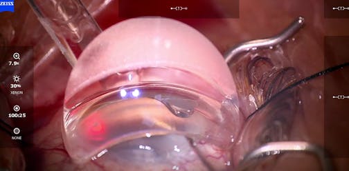 Pressurized Viscodelivery With iTrack Advance