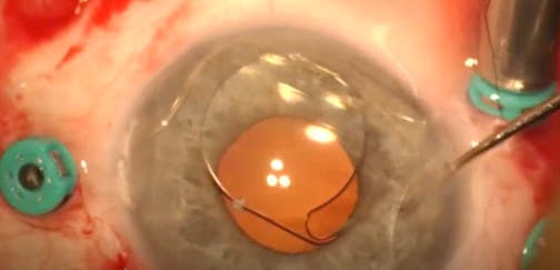 A Well-Positioned ACIOL - Eyetube