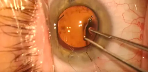 Insertion of an Adjustable IOL and Postoperative Options