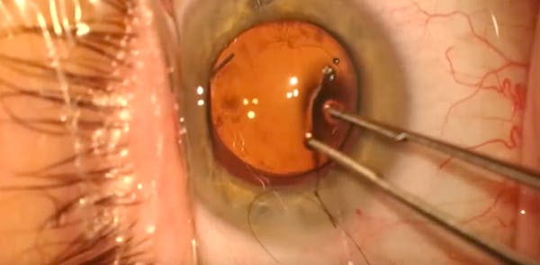 Insertion of an Adjustable IOL and Postoperative Options thumbnail