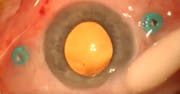 Managing Chemosis After a Posterior Sub-Tenon Anesthetic Block