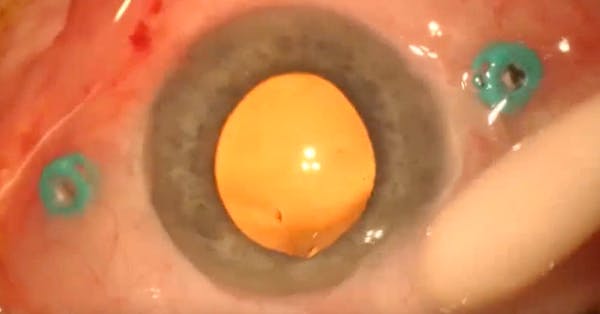 Managing Chemosis After a Posterior Sub-Tenon Anesthetic Block thumbnail