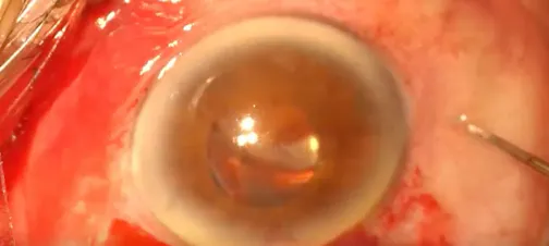 Modified Shakir Cannula Insertion Technique