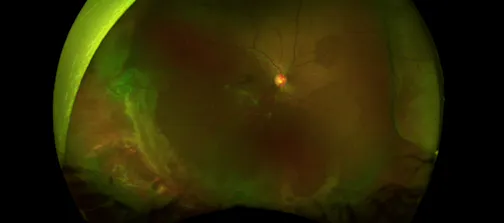 A Modified Endolaser Instrument for Chandelier Scleral Buckles