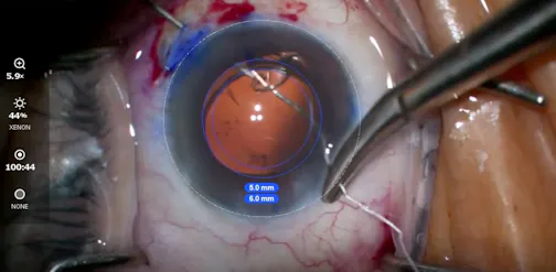 Scleral Fixation of a Subluxated Toric IOL