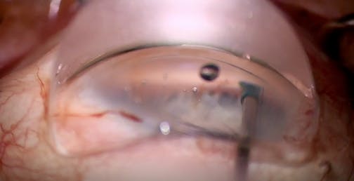 Viscodelivery Into the Canal