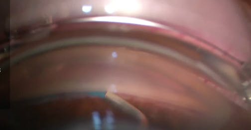 360-Degree Canaloplasty and 180-Degree Nasal Trabeculotomy