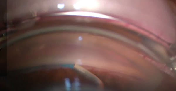 360-Dregree Canaloplasty and 180-Degree Nasal Trabeculotomy thumbnail