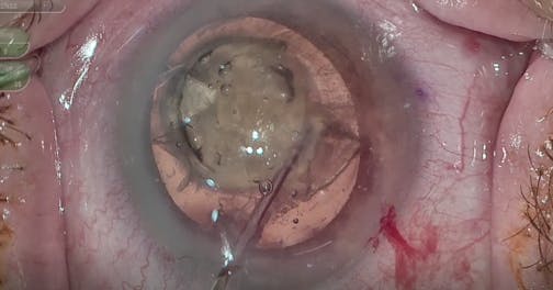 Role Reversal: Femtosecond Upgrade Allows Phaco to Become the Second Instrument