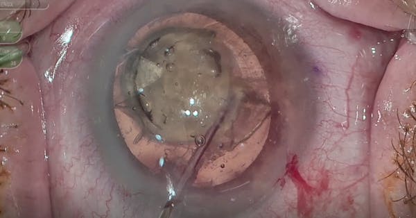 Role Reversal: Femtosecond Upgrade Allows Phaco to Become the Second Instrument thumbnail