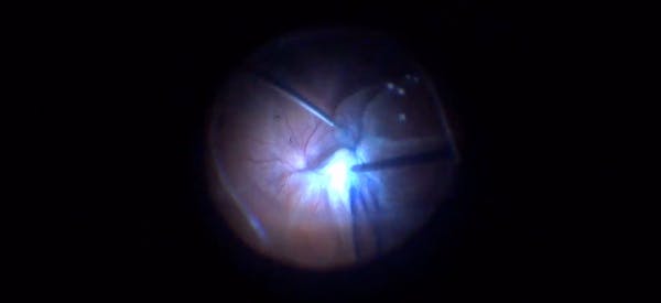 Retinal Detachment With Star Folds thumbnail