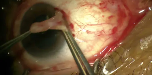 Glueless, Sutureless Pterygium Surgery With Amniotic Membrane