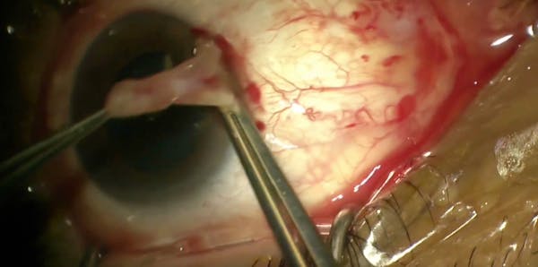 Glueless, Sutureless Pterygium Surgery With Amniotic Membrane thumbnail