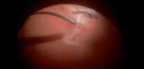Minimally Invasive Vitrectomy in Patient With Behçet Disease and Proliferative Vitreoretinopathy