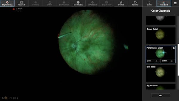 Enhanced Visualization During Epiretinal Membrane Peel thumbnail