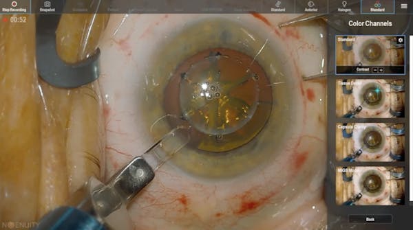 Contrast Visualization During Cataract Surgery thumbnail