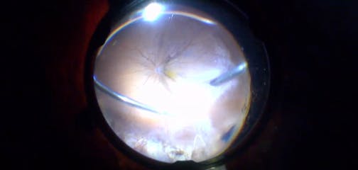 300-Degree Retinectomy