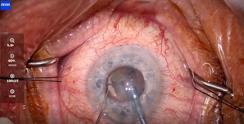 Managing a Small Pupil