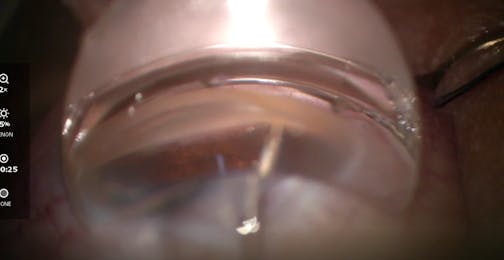 Goniotomy With KDB Glide