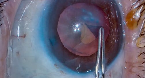 Capsulorhexis With Digital Enhancement